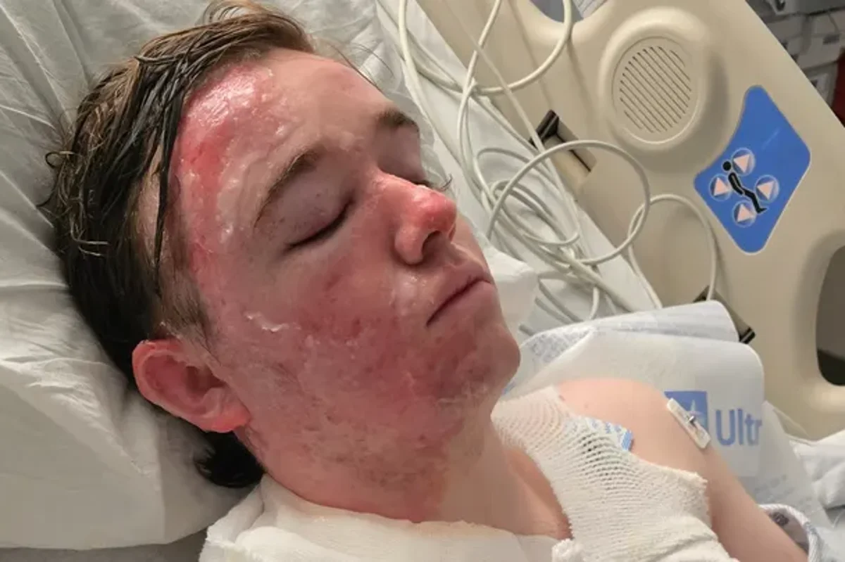 A McDonald's employee with second-degree burns all over their body after a co-worker allegedly threw hot oil on them, highlighting the importance of workplace safety and the need for employers to take a proactive approach to protecting their employees