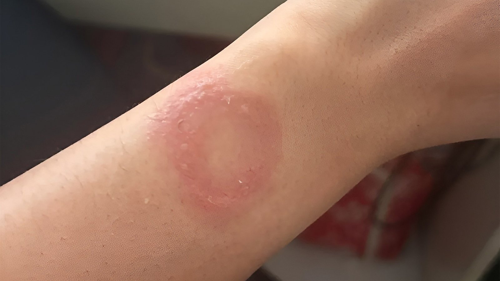 A person wearing an Apple Watch on their wrist, with a red burn mark visible, symbolizing the wrist burn incident, with a blurred background of a laptop and other tech devices, highlighting the importance of customer support in the UK